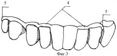 Усовершенствованная несъемная стоматологическая шина и способ ее крепления (патент 2422115)