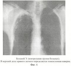 Способ хирургического лечения туберкулеза легких (патент 2417762)