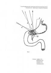 Способ арефлюксной пилоропластики при недостаточности пилорического сфинктера и синдроме шмидена (патент 2663388)