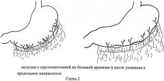 Способ удлинения желудочного трансплантата (патент 2454949)