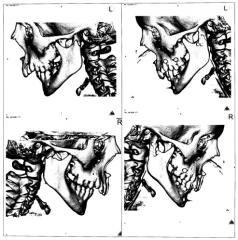 Способ лечения переломов мыщелкового отростка нижней челюсти со смещением и вывихом головки под основание черепа у детей с использованием эндоскопической техники (патент 2455952)