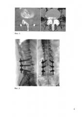 Способ лечения больных с поясничным спинальным стенозом (патент 2631637)