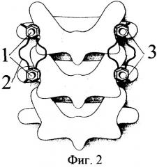Устройство для внутренней транспедикулярной фиксации позвоночника (патент 2326617)