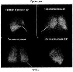 Способ дифференциальной диагностики острых инфекционных заболеваний легких и тромбоэмболий мелких ветвей легочной артерии (патент 2310385)