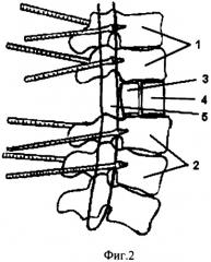 Способ хирургического лечения последствий переломов позвоночника (патент 2279859)