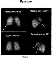 Способ дифференциальной диагностики острых инфекционных заболеваний легких и тромбоэмболий мелких ветвей легочной артерии (патент 2310385)