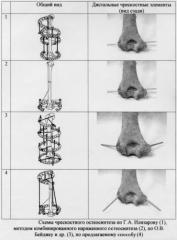 Способ комбинированного чрескостного остеосинтеза плечевой кости (патент 2270631)