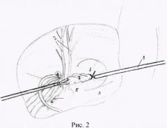 Способ укрепления пахового канала при прямой паховой грыже путем пластики поперечной фасции эндопетлей (патент 2498778)