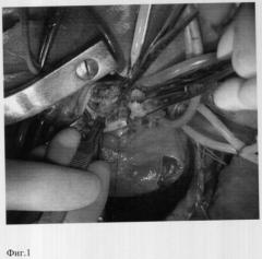 Способ реконструкции пути оттока левого желудочка при экстравальвулярном разрушении устья аорты (патент 2300320)