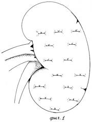Способ нефропексии (патент 2284159)