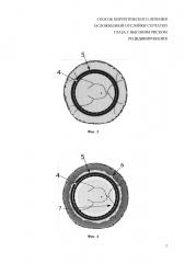Способ хирургического лечения осложненной отслойки сетчатки глаза с высоким риском рецидивирования (патент 2628651)