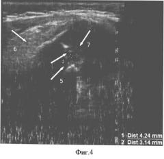 Способ ультразвуковой диагностики острого гематогенного метаэпифизарного остеомиелита у детей грудного возраста (патент 2503413)