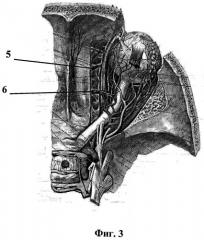Окончательная остановка носового кровотечения при травме решетчатого лабиринта с использованием эндоскопической техники и инструмента (патент 2495629)
