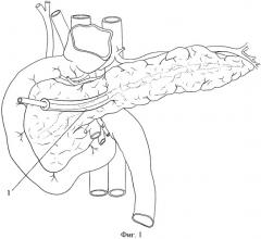 Способ хирургического лечения свищей поджелудочной железы (патент 2445023)