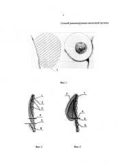 Способ реконструкции молочной железы (патент 2620686)