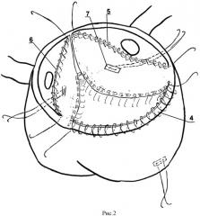 Способ укрепления стенки синусов вальсальвы и имплантации протеза аортального клапана при выполнении операции wheat (патент 2511457)