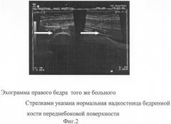 Способ ранней ультразвуковой диагностики периостита трубчатых костей (патент 2277858)