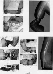 Способ реконструкции плеча у детей с последствиями травмы (патент 2266069)