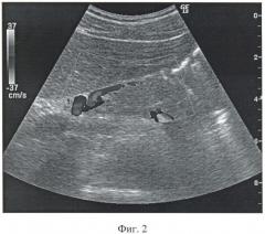 Способ дуплексного сканирования левой желудочной артерии (патент 2393770)