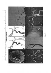 Способ восстановления кровотока при сочетанном тромбозе внутренней сонной и средней мозговой артерий (патент 2629046)