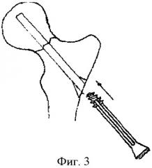 Устройство для остеосинтеза при переломах шейки бедра (патент 2332953)