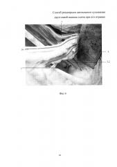 Способ реинсерции дистального сухожилия двуглавой мышцы плеча при его отрывах (патент 2663384)