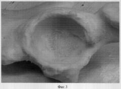 Способ костной пластики дефектов медиальной стенки вертлужной впадины при ревизионной артропластике, обусловленной нестабильностью вертлужного компонента тотального эндопротеза тазобедренного сустава (патент 2309688)