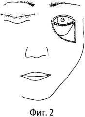 Способ закрытия обширных дефектов кожи век, распространяющихся на область наружного угла глаза и окружающие зоны лица (патент 2305519)