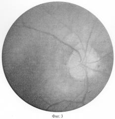 Способ прогнозирования эффективности лечения при частичной атрофии зрительного нерва (патент 2282391)