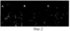 Применение стромальных стволовых клеток жировой ткани для лечения свищей (патент 2435846)