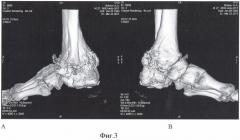 Способ реконструкции заднего отдела стопы при утрате пяточной кости (патент 2488360)