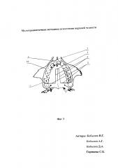 Малотравматичная методика остеотомии верхней челюсти (патент 2625897)