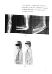 Способ восстановления функции локтевого сустава при неправильно сросшихся переломах мыщелка плечевой кости (патент 2581711)