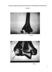 Способ лечения переломов головчатого возвышения плечевой кости у детей (патент 2650603)