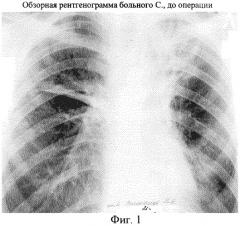 Способ хирургического лечения туберкулеза легких (патент 2246263)