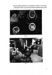 Способ выполнения селективного эикма в регионе гипоперфузии с использованием нейронавигации (патент 2648001)