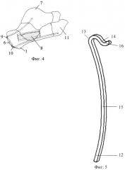 Способ хирургического лечения внутрисуставного компрессионного перелома пяточной кости и скоба для его осуществления (патент 2535451)