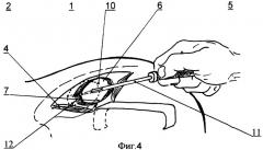 Способ забора аутотрансплантата для костной пластики (патент 2371127)