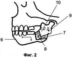 Способ аллопластики при микрогнатии нижней челюсти (патент 2310412)