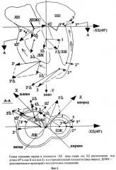 Способ локализации дополнительных проводящих путей при синдроме вольфа-паркинсона-уайта с помощью вектор-электрокардиографии (патент 2268640)