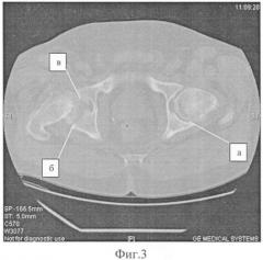 Способ обоснования выбора тазобедренного сустава при эндопротезировании больных двусторонним коксартрозом (ка) с одинаковой рентгенологической стадией дегенеративного процесса (патент 2417754)