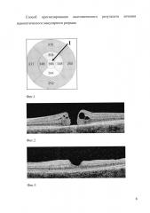 Способ прогнозирования анатомического результата лечения идиопатического макулярного разрыва (патент 2597571)