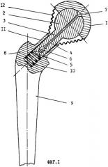 Эндопротез тазобедренного сустава (патент 2245688)