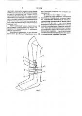 Устройство жеребного для создания компрессии при лечении переломов в гипсовых повязках (патент 1616652)