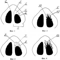 Способ устранения деформации крыла носа (патент 2621383)