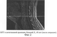 Способ оценки результатов лазерной увулопалатопластики у пациентов с синдромом обструктивного сонного апноэ в сочетании с феноменом храпа (патент 2295315)