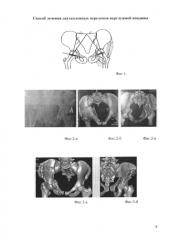 Способ лечения двухколонных переломов вертлужной впадины (патент 2581270)