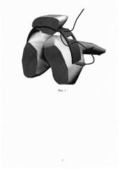 Способ реконструкции разгибательного аппарата коленного сустава (патент 2661436)