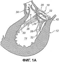 Устройство и способ для улучшения работы сердечного клапана (патент 2536701)