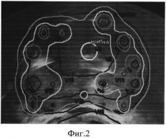 Способ планирования высокодозной внутритканевой лучевой терапии рака предстательной железы (патент 2576875)